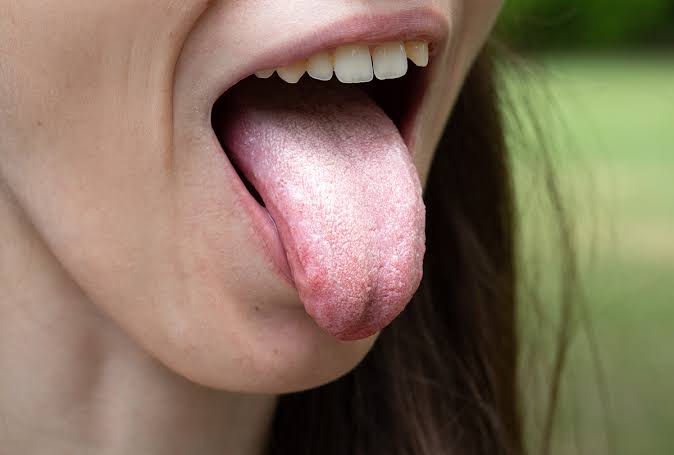 What Causes White Layer On Tongue?